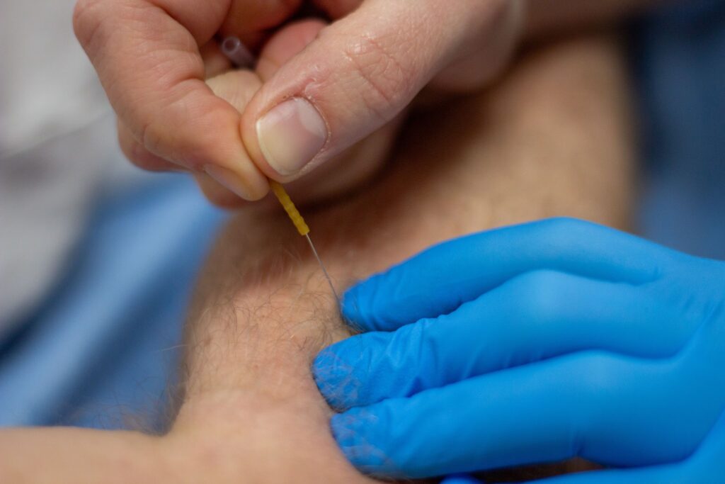 Patiënt krijgt dry needling bij terugkerende spierklachten.