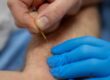 Patiënt krijgt dry needling bij terugkerende spierklachten.